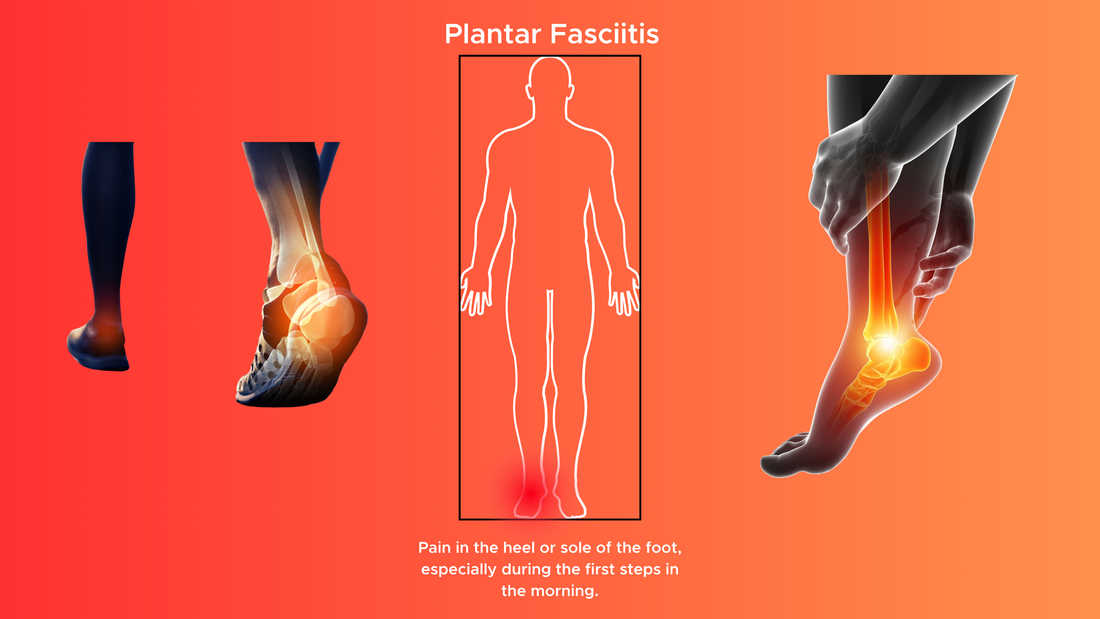 Plantar Fasciitis: Walking on Fire